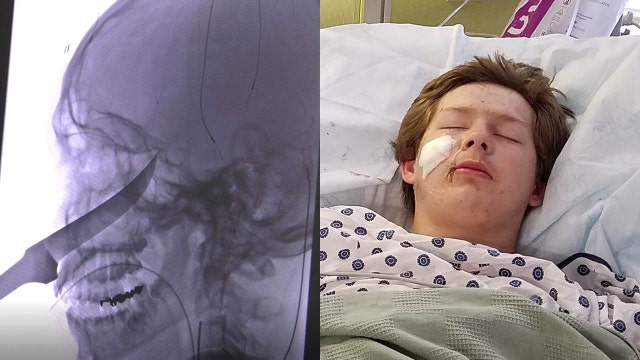 Kansas teen miraculously survives 10-inch knife in face: 'It was really shocking'