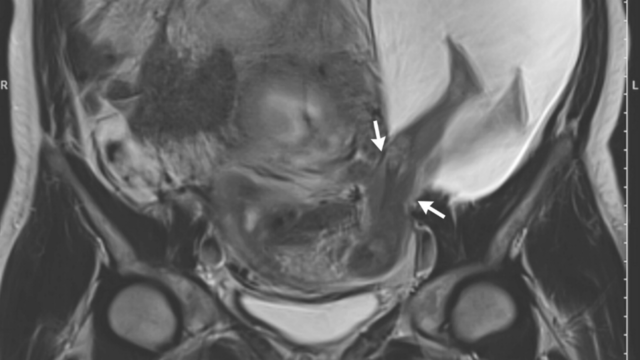 Doctor discovers baby's legs protruding from mother's womb