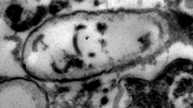 Man claims he contracted eye-eating parasite from amusement park water ride