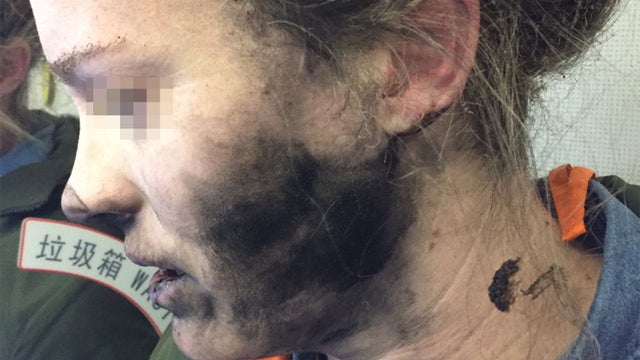 Woman burned after headphones explode during flight