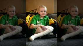 Mom seeks birthday cards for son with rare skin disorder: 'His life depends on this'