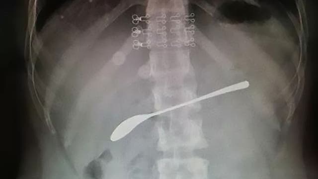 Drunk woman swallowed 6-inch spoon and forgot, report says