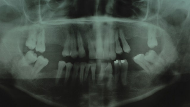 Boy has over 500 'teeth' removed after complaining of pain in jaw