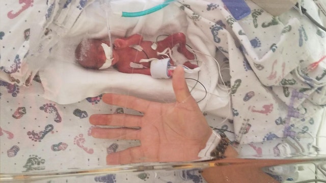 ‘Remarkable': Tiny baby born weighing just 13 ounces wows doctors with progress