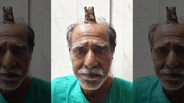 Man has 4-inch 'devil horn' removed from head