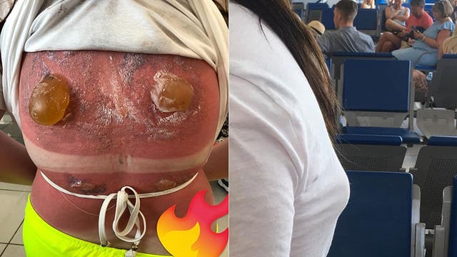 English girl, 16, suffers horrific sunburn on back after snorkeling in Cuba