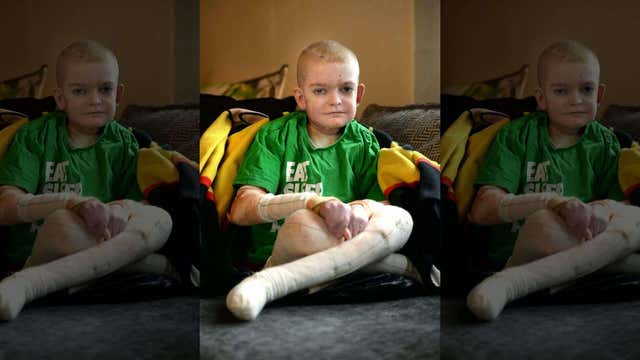 Mom seeks birthday cards for son with rare skin disorder: 'His life depends on this'