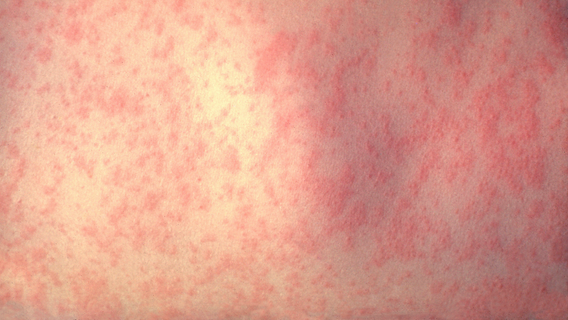 Collin County confirms one middle school student has measles
