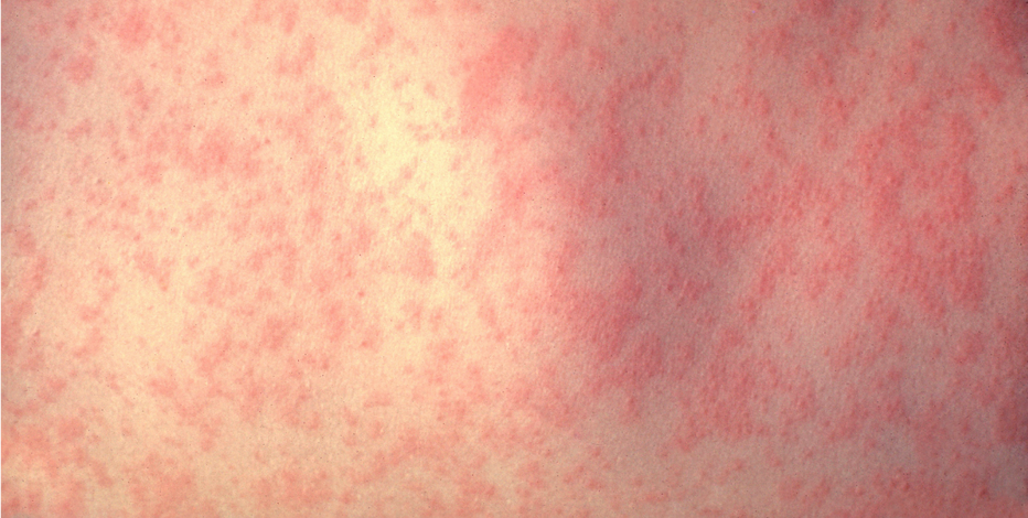 Collin County confirms one middle school student has measles