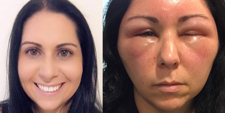 Woman's allergic reaction to hair dye causes severe swelling in face, head Woman's allergic reaction to hair dye causes severe swelling in face, head