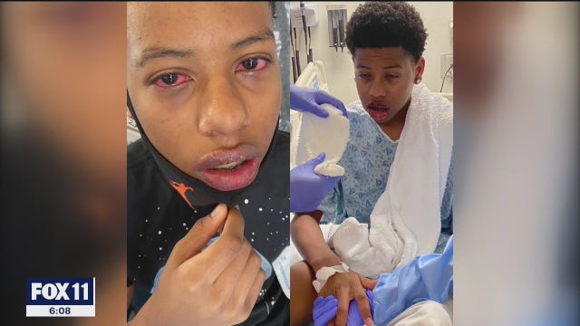 Lakewood boy, 16, shares his story after difficult battle with COVID-19 following birthday party