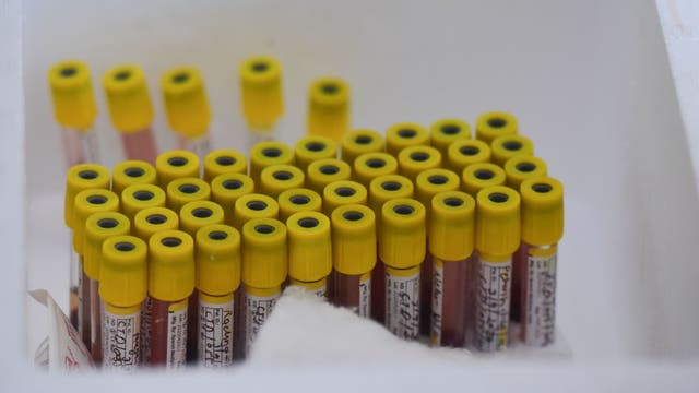 'A lot of wishful thinking': Experts say usefulness of COVID-19 antibody tests still unclear