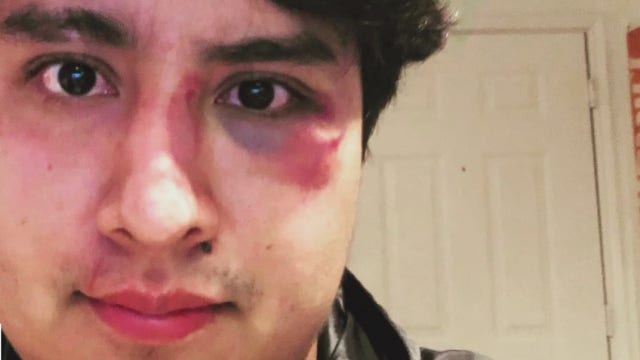 Citizen journalist attacked during demonstration home from the hospital