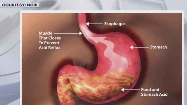 Growing number of people under 50 getting esophageal cancer diagnosis