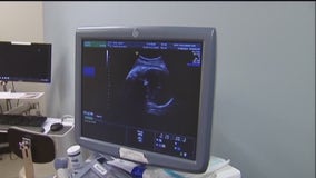 Abortion ‘heartbeat bill’ wins critical vote in Texas House