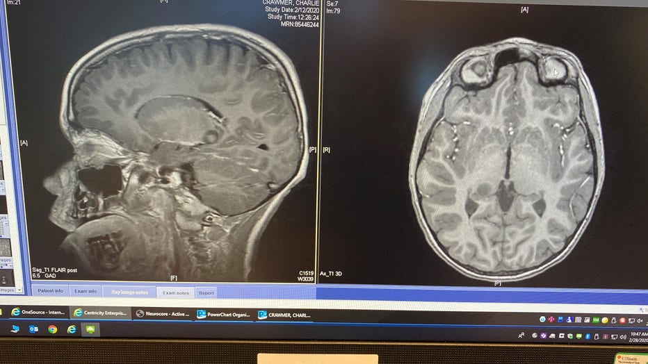 Charlie-brain-scan.jpeg
