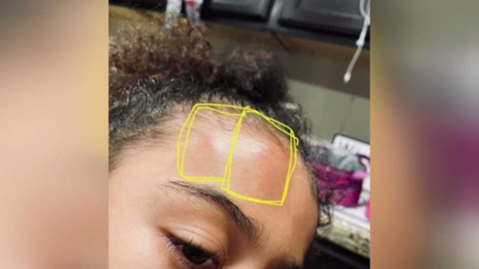 Bruises-of-6-year-old-girl-bullied-at-school.jpg