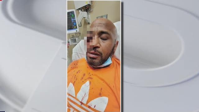 'I'm in total disbelief,' says Houston man punched so hard doctors had to remove an eye