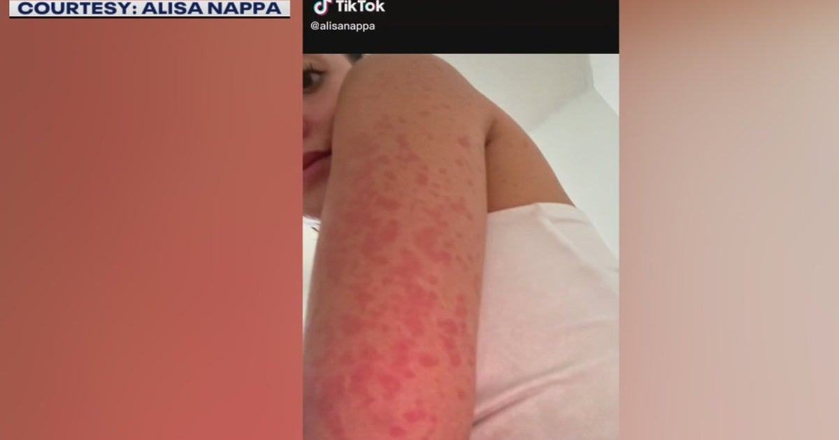 Lake Crab Rash Woman contracts rash after spending time in Lady Bird Lake, Barton ...