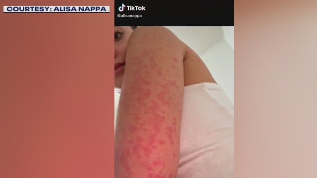 Woman contracts rash after spending time in Lady Bird Lake, Barton Springs