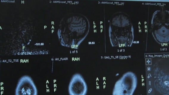 Dell Seton takes part in global study into thrombectomies