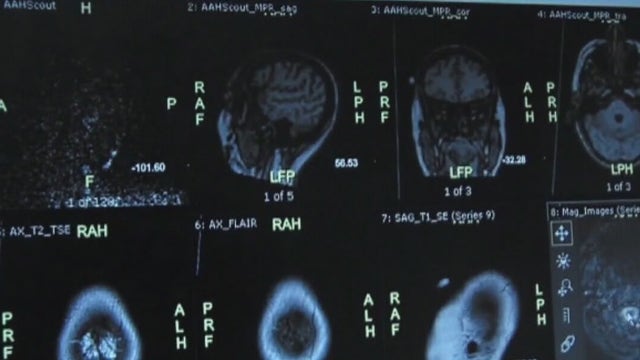 Dell Seton takes part in global study into thrombectomies