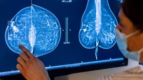 New FDA rule requires info on breast density with all mammograms