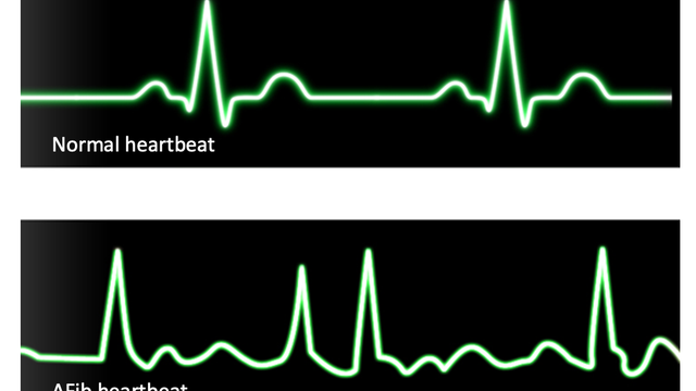 Afib could increase risk of developing dementia: study