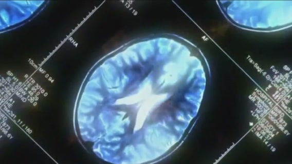 New therapy hopes to treat Alzheimer's disease