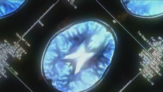New therapy hopes to treat Alzheimer's disease