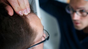 New hair loss treatments may be on the way after major discovery, researchers say