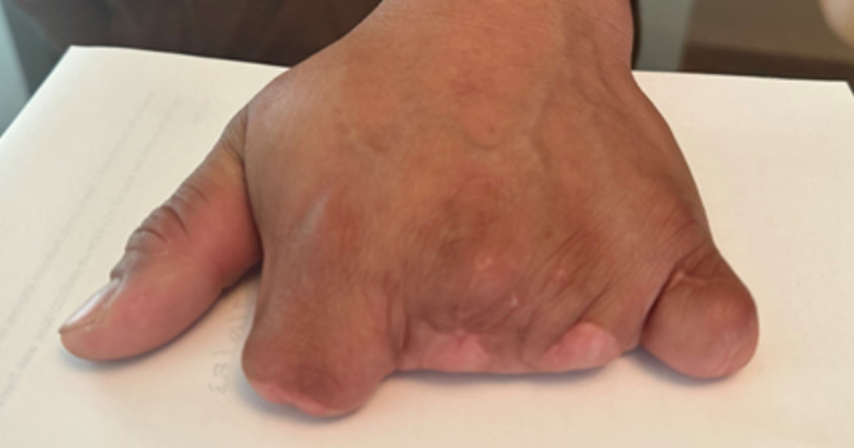 La Barbecue cook who lost four fingers on the job sues restaurant ...