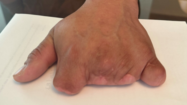 La Barbecue cook who lost four fingers on the job sues restaurant for injuries, fraud