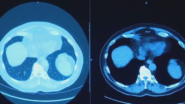 Lung cancer survivor in Austin advocates for screening, detection