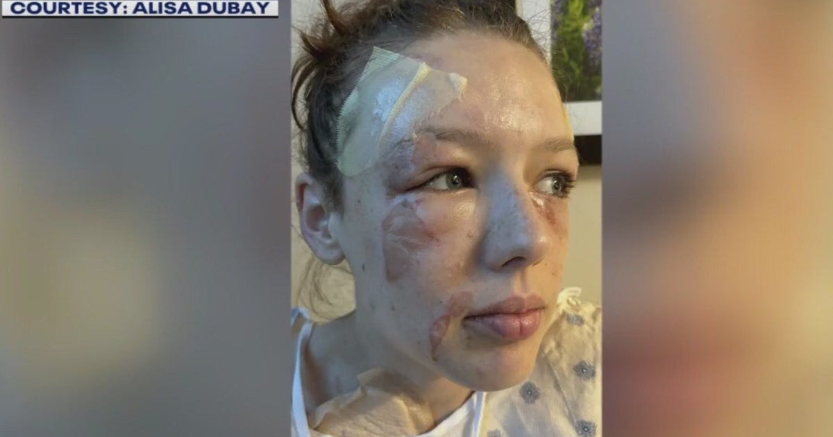 Texas State student recovering after grease fire accident | FOX 7 Austin