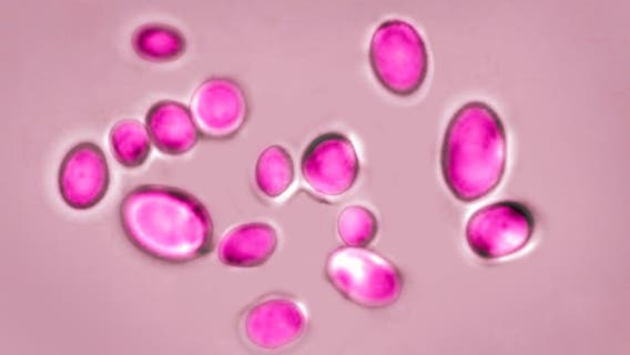 Texas leads US in cases of dangerous fungal infection
