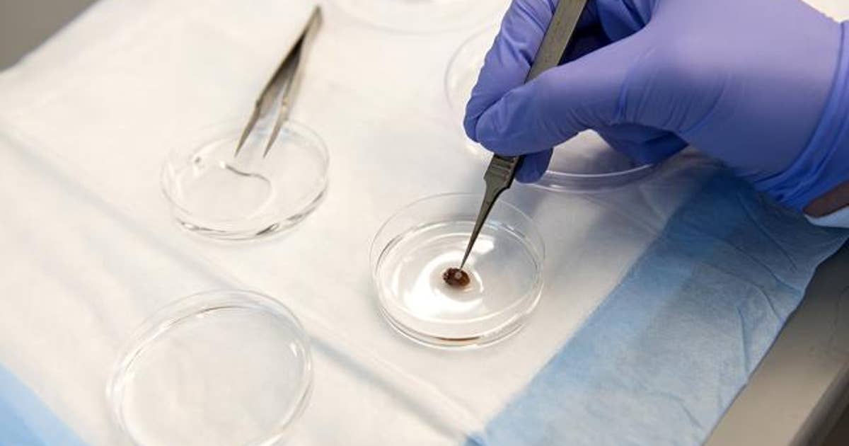U of M researchers develop 3-D printed patch could help heart attack ...