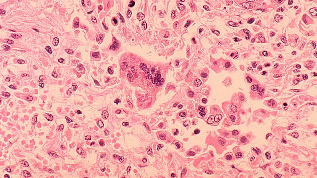 Two cases of measles confirmed in preschool siblings in Minnesota