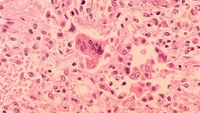 2 cases of measles confirmed in Minnesota preschool siblings