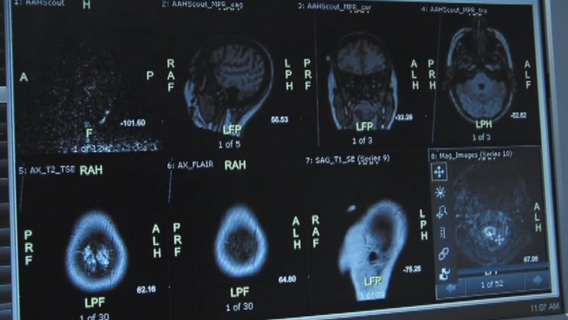 Man cracks his neck, lands in hospital with stroke