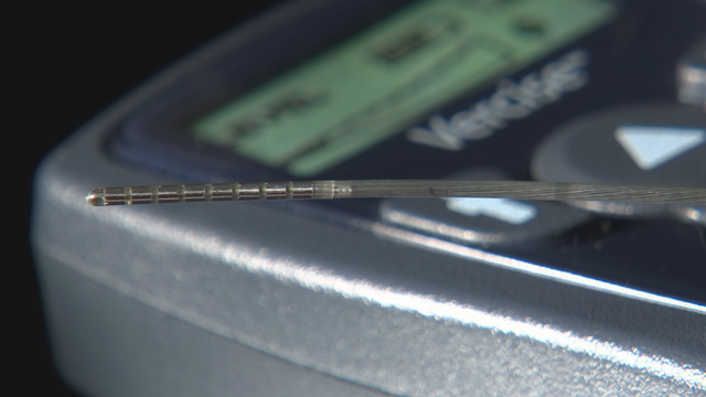 U of M Health leads the way with new treatment for Parkinson's disease