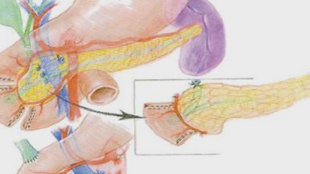 U of M pancreatitis procedure reaches major milestone