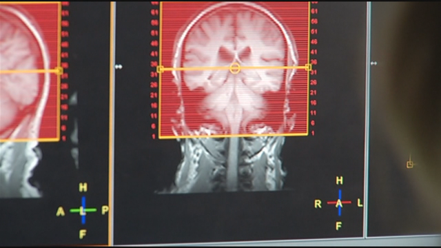 Alzheimer's blood test could help efforts to diagnose disease early