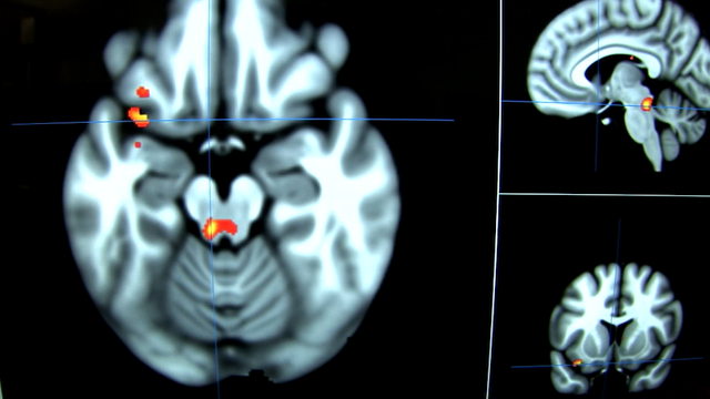 Brain scans may help depression patients find the right treatment