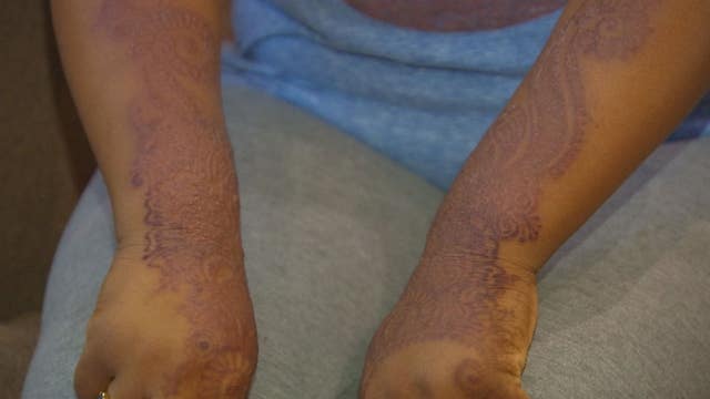 Henna tattoo reaction leaves woman swollen, blistered