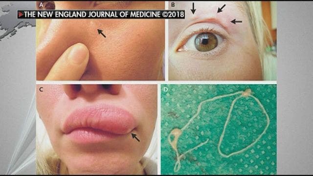 Migrating bump on woman's face turned out to be a worm