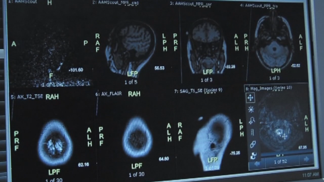 Man cracks his neck, lands in hospital with stroke