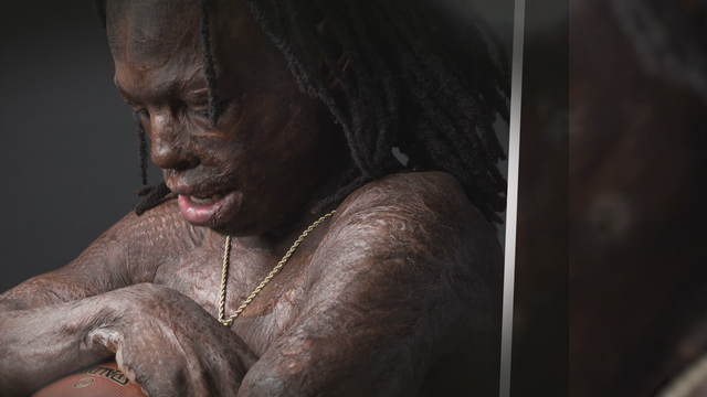 Former Minneapolis football player who survived fire as child awarded scholarship