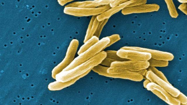 Tuberculosis case at St. Louis Park HS, testing clinics scheduled