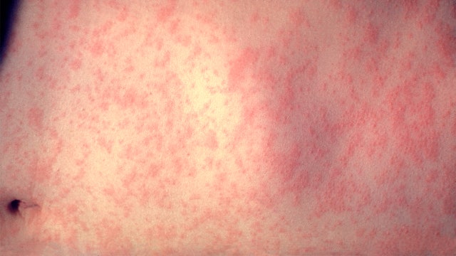Measles cases rise in New York; approaching record numbers